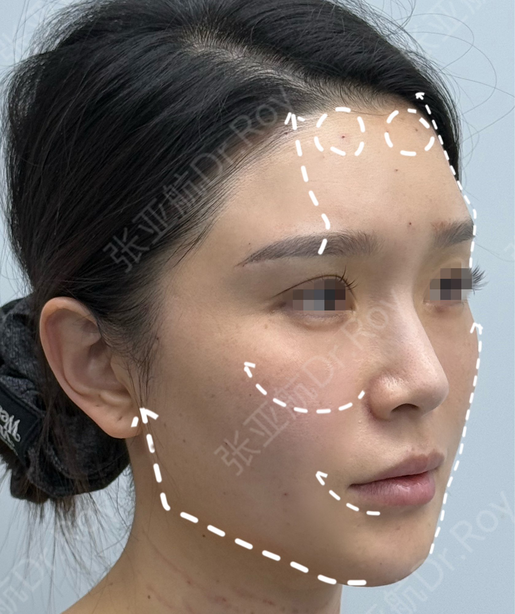JuveFace® 授权案例 01 侧面