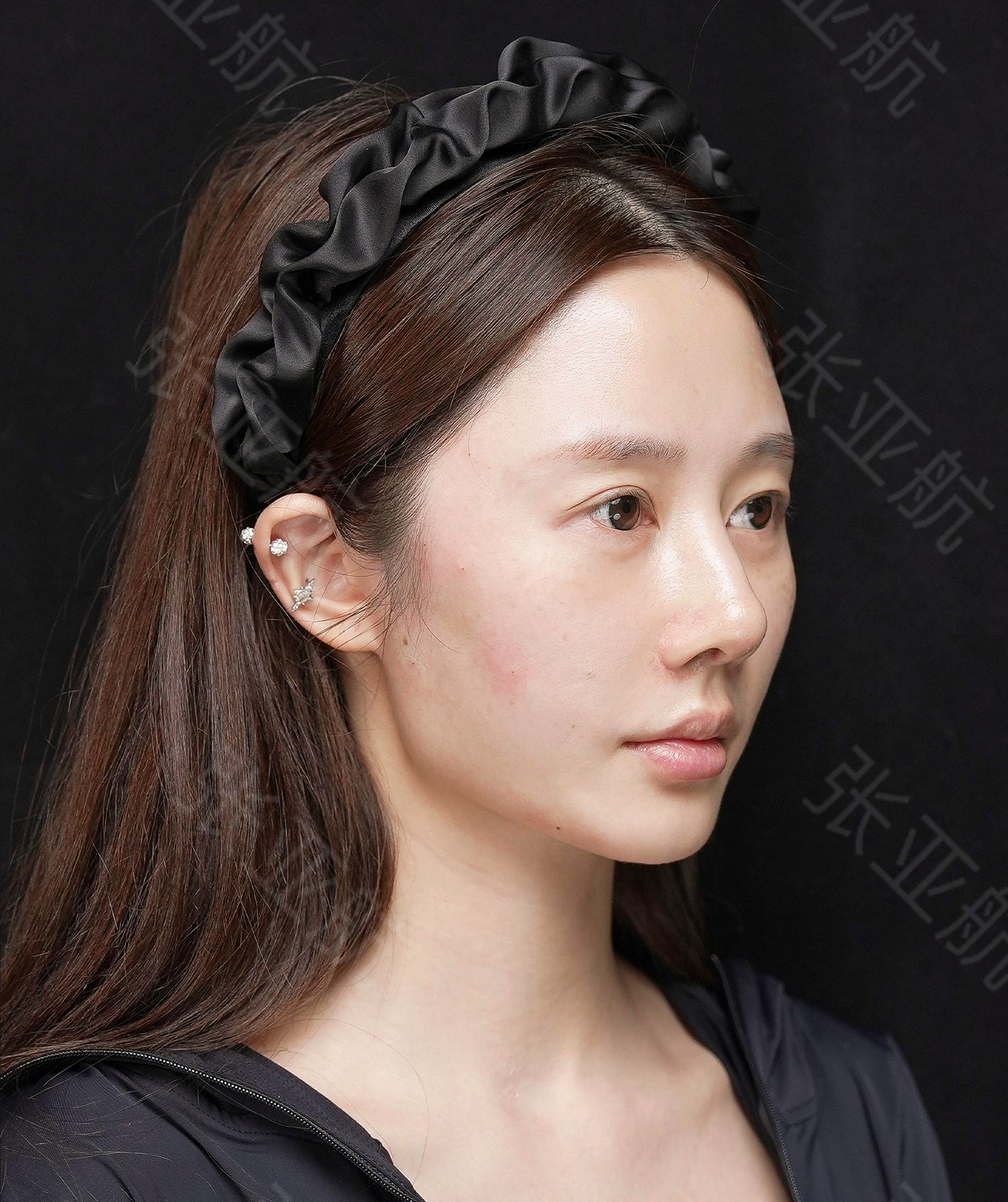 JuveFace® 授权案例 02 侧面